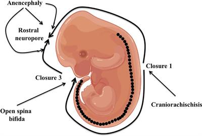 A quest for genetic causes underlying signaling pathways associated with neural tube defects